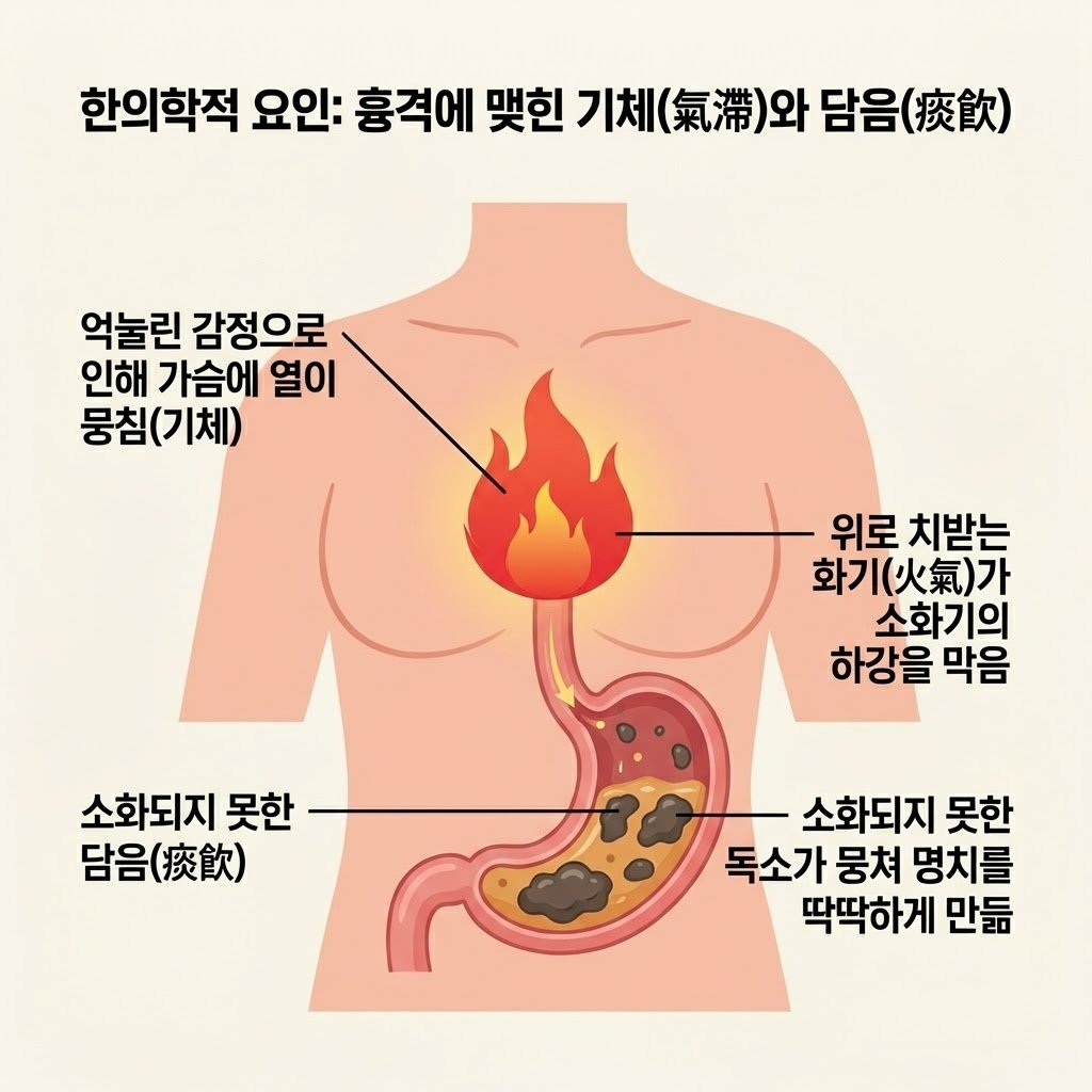 화병 기체증 명치 통증 간기울결 담음