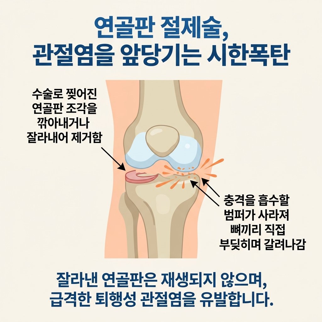 연골판 절제술 부작용 퇴행성 관절염 뼈 마찰