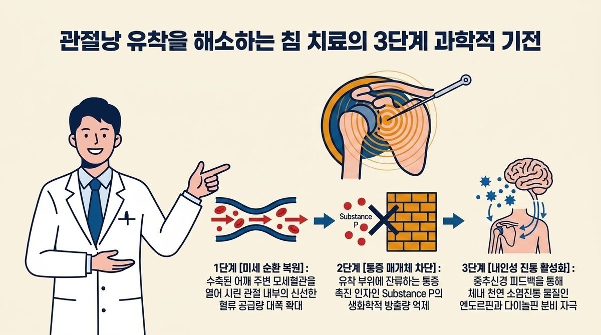 침 자극이 어깨 관절낭 염증을 가라앉히고 내인성 오피오이드를 방출하는 생화학 기전 인포그래픽