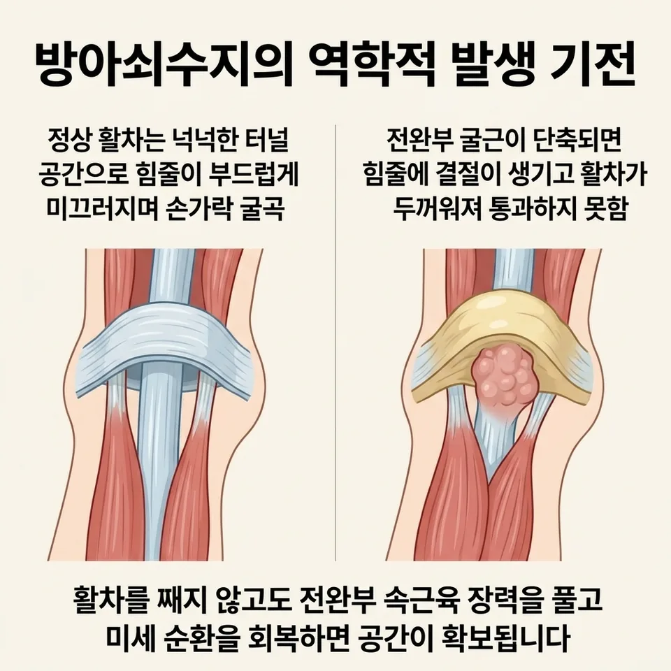 방아쇠수지 발생 기전