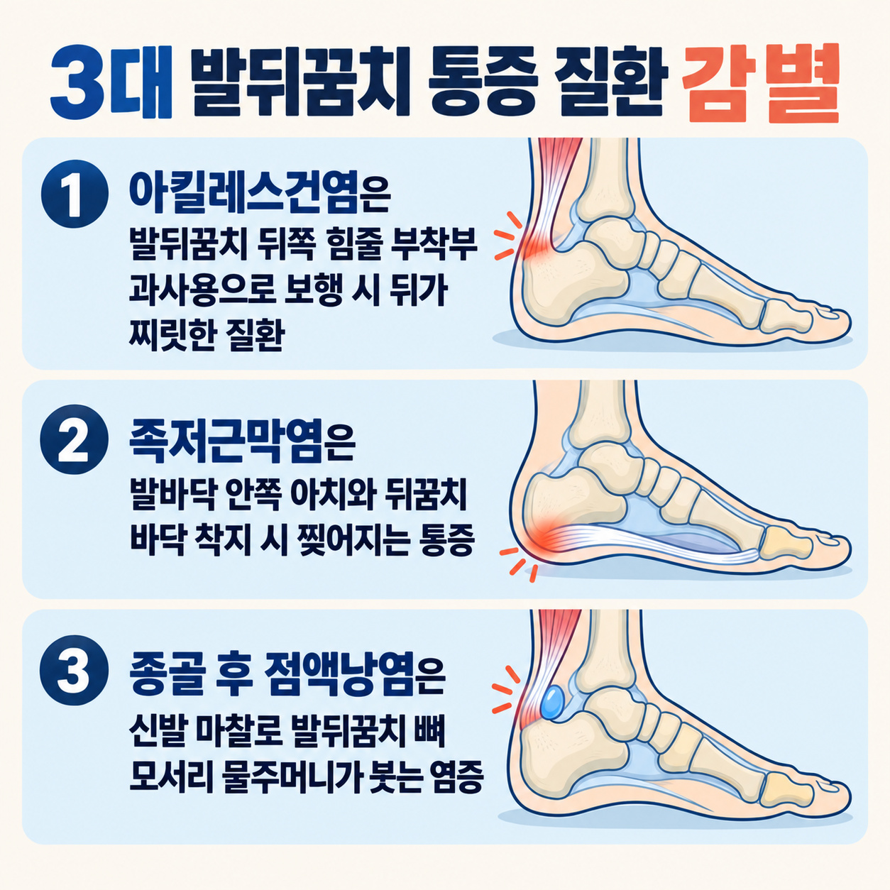 3대 발뒤꿈치 통증 질환 감별 인포그래픽