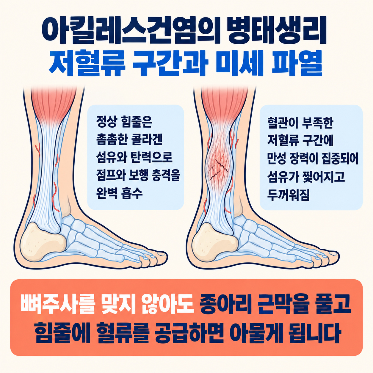 아킬레스건염 병태생리 저혈류 구간과 미세 파열