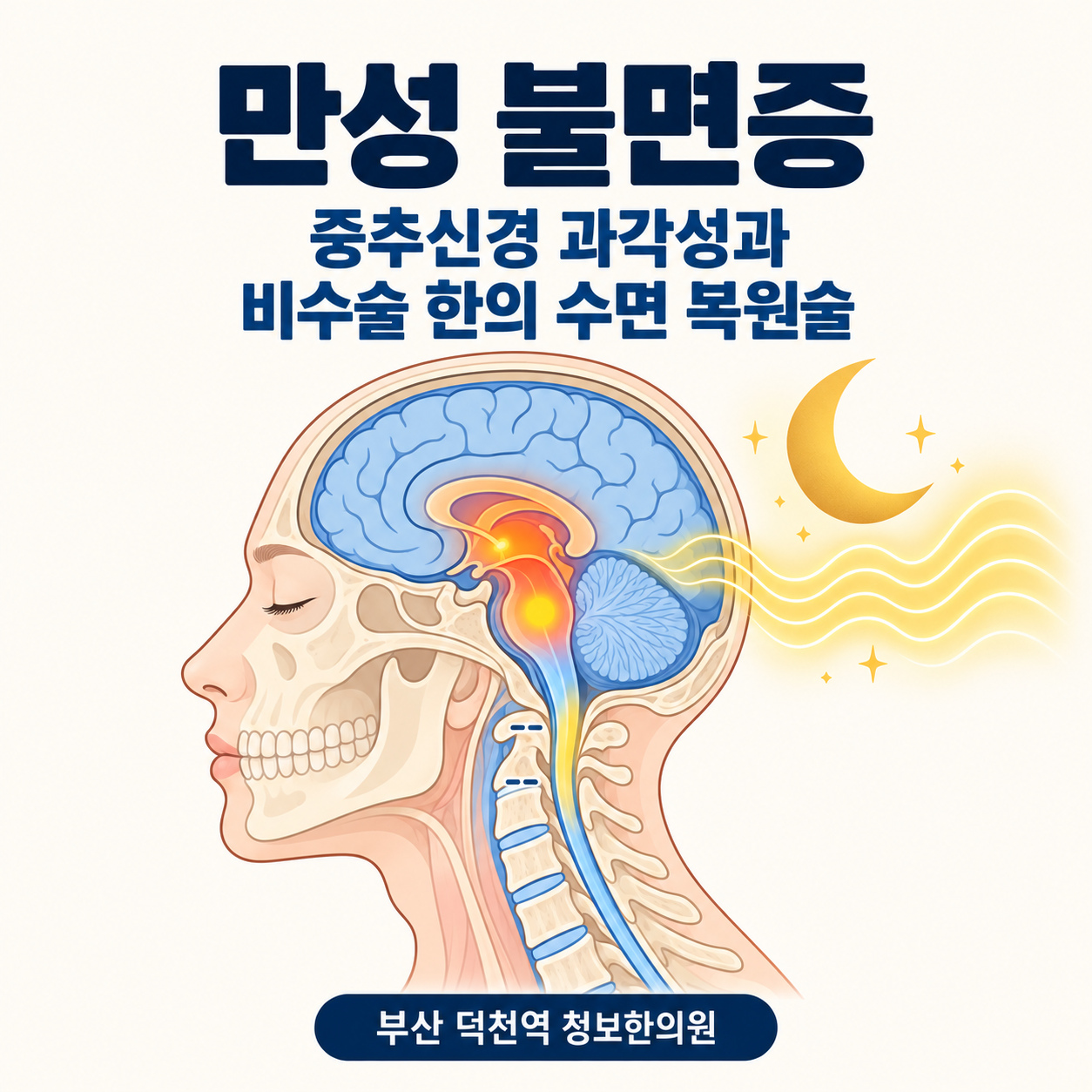 만성 불면증 중추신경 과각성과 비수술 한의 수면 복원술 인포그래픽