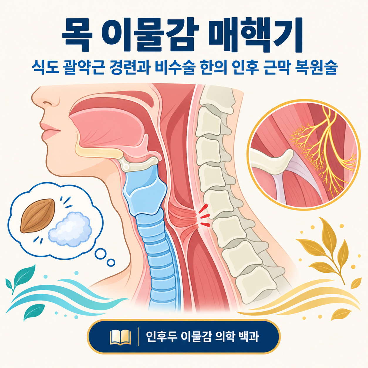 매핵기 비수술 인후두 근막 복원술 인포그래픽