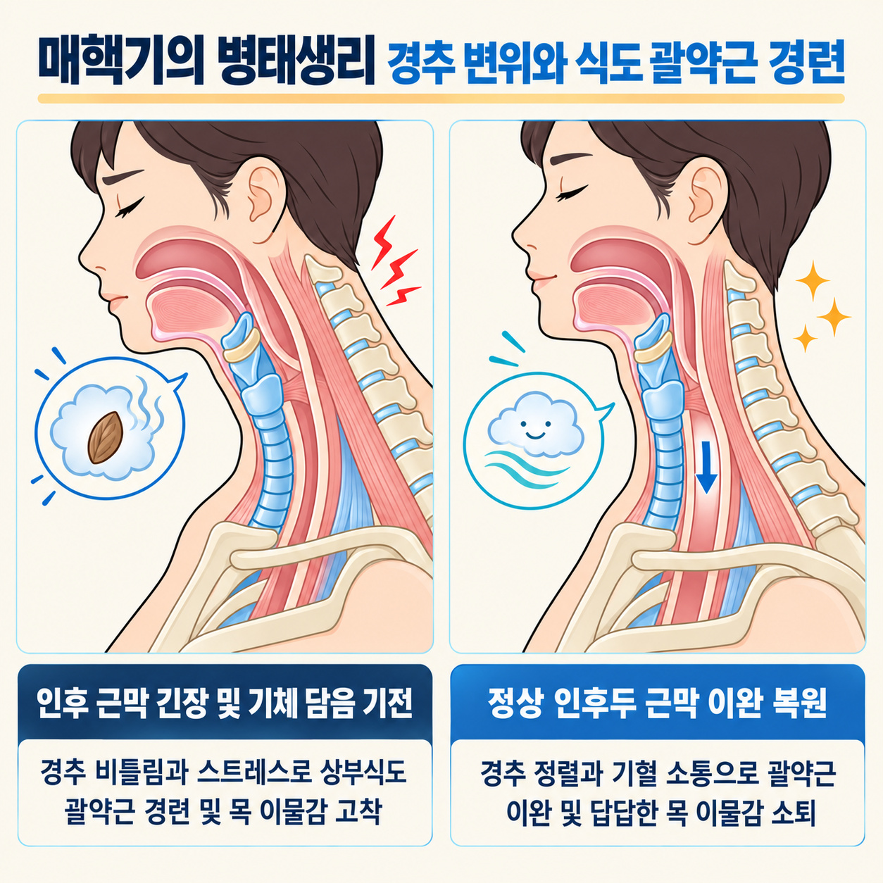 매핵기의 병태생리 경추 변위와 식도 괄약근 경련 인포그래픽