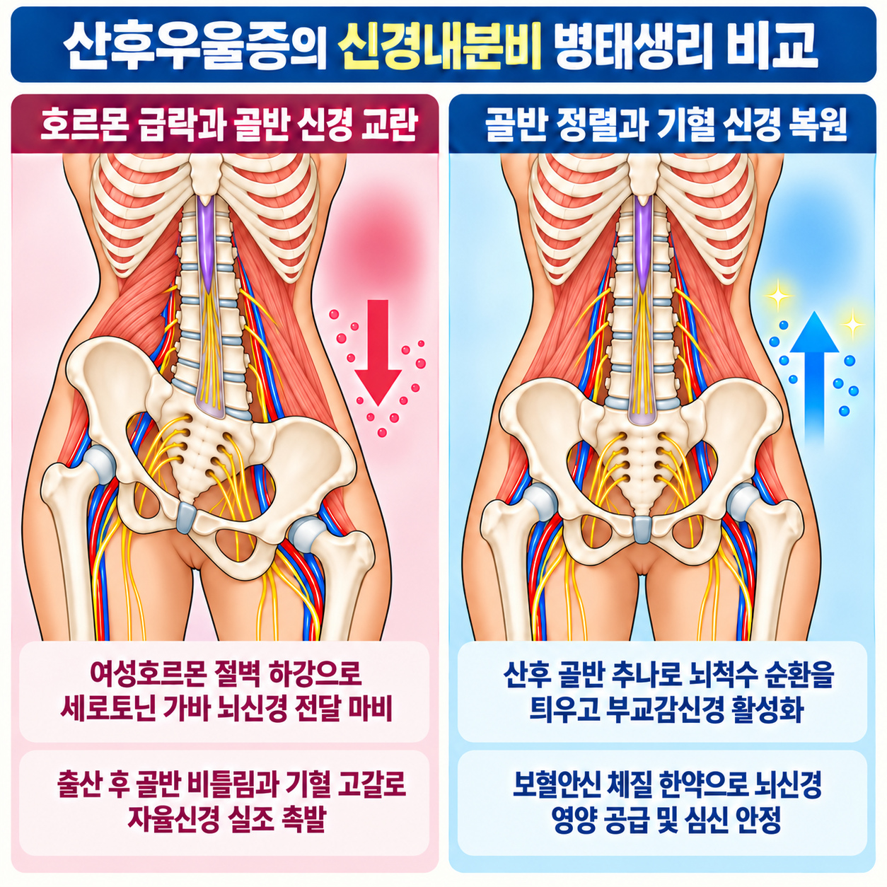 산후우울증 신경내분비 병태생리 비교 인포그래픽